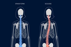 Does Scoliosis Get Worse With Age