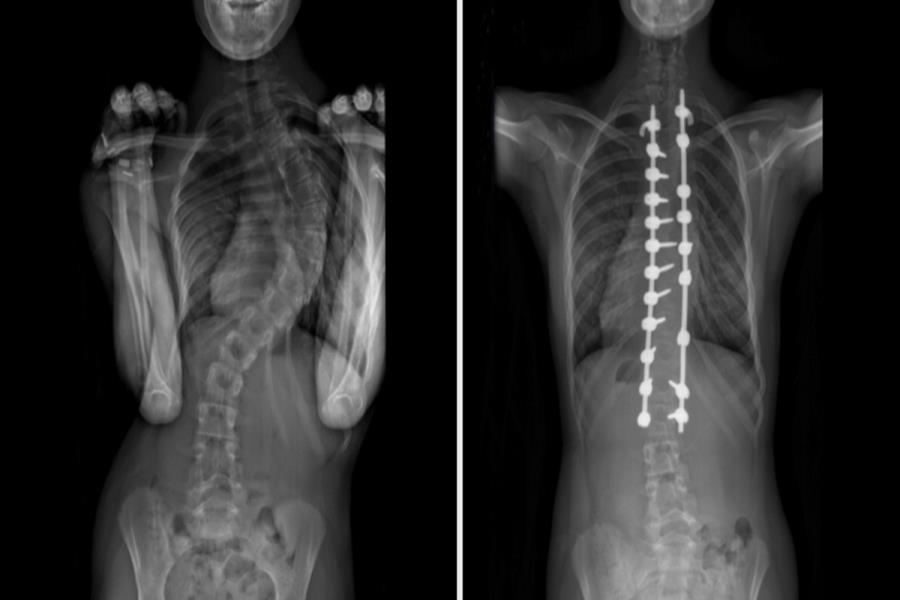 Does Scoliosis Get Worse With Age Picture